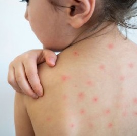 Nación primero, y provincia de Buenos Aires después, confirmaron un caso de sarampión